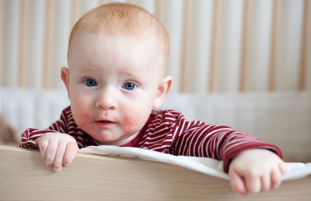 Atopinis dermatitas – ar visada alergija?