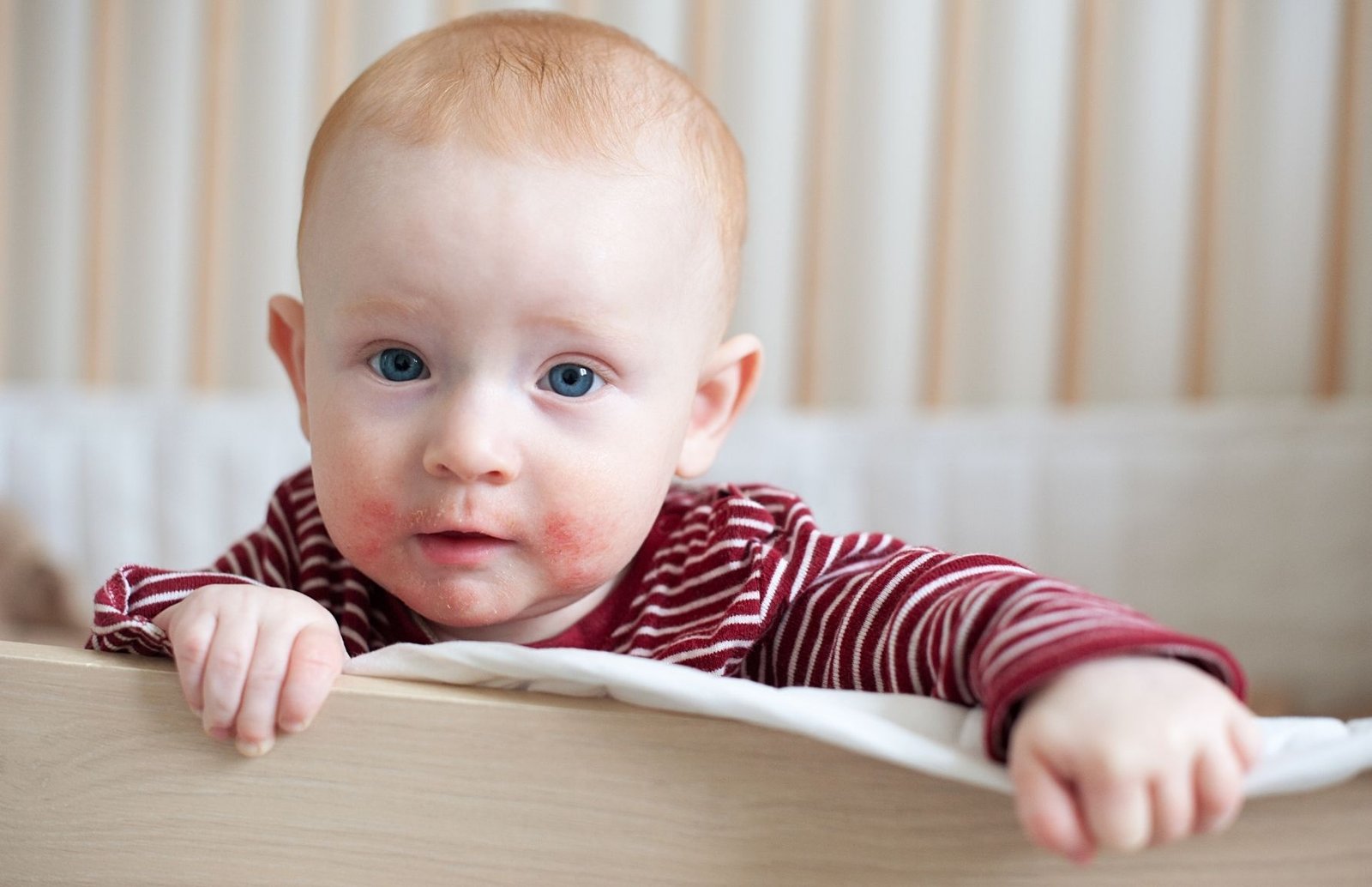 Atopinis dermatitas – ar visada alergija?