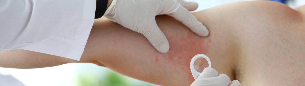 Histamino netoleravimas: simptomai, priežastys ir kaip jį kontroliuoti