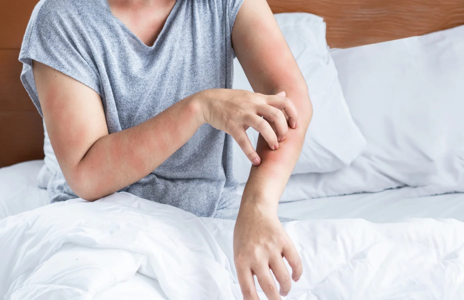 Histamino netoleravimas: simptomai, priežastys ir kaip jį kontroliuoti