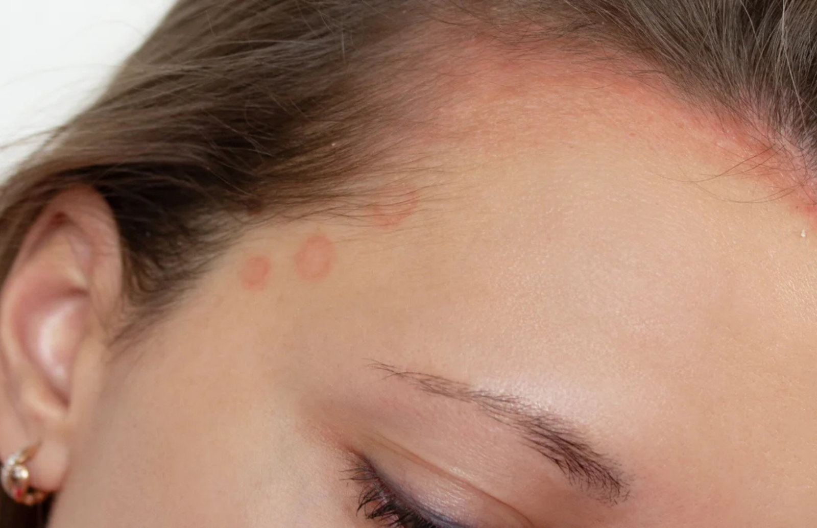 Kai plaukų priežiūra sukelia kontaktinę alergiją arba alergija plaukų priežiūros priemonėms