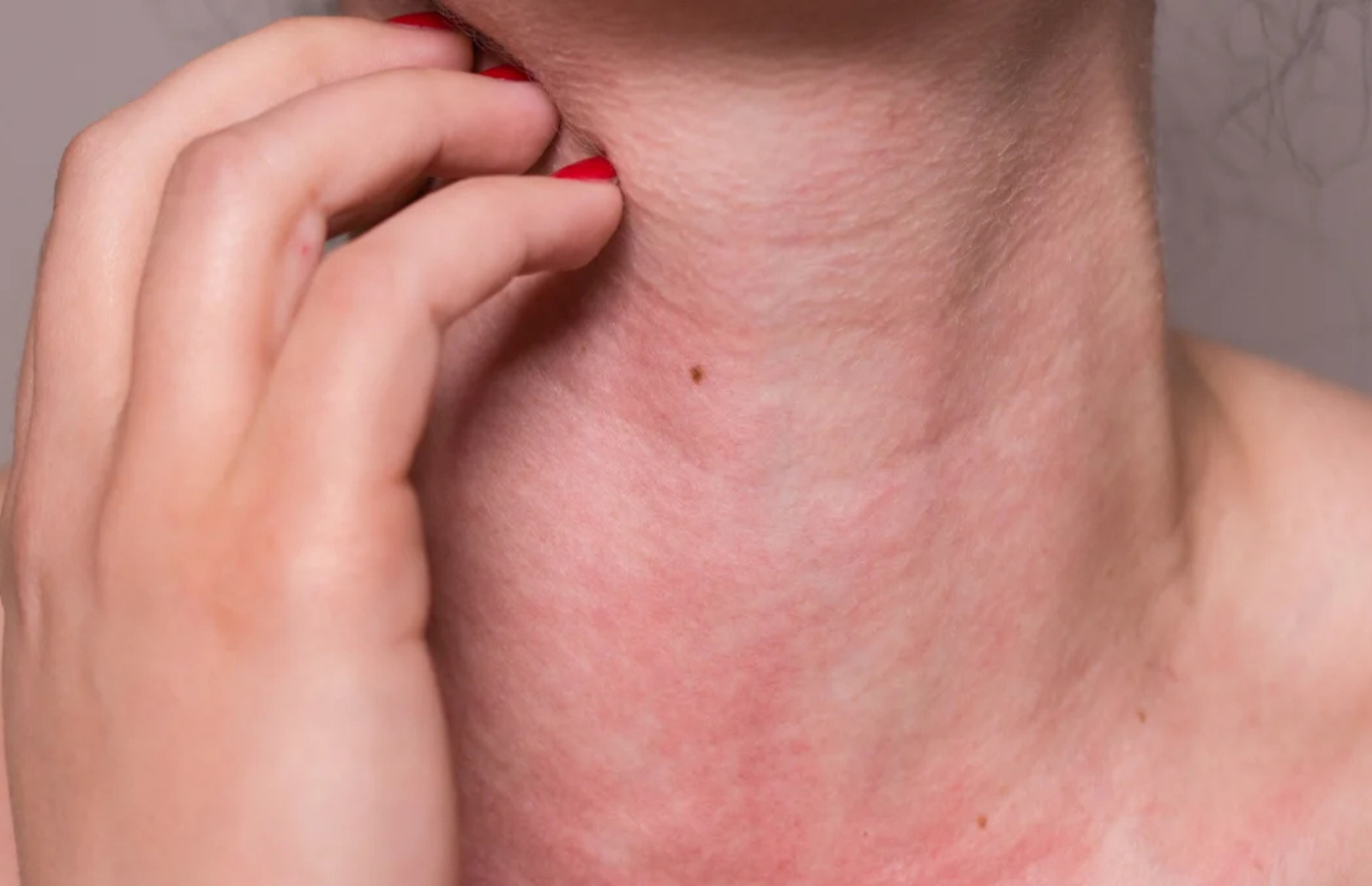 Alergija saulei arba apsauga nuo saulės visiems - mažiems, dideliems ir jautriems