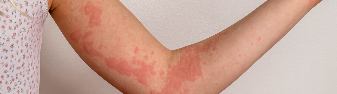 Alergija kviečiams kviečių sukelta kontaktinė dilgėlinė