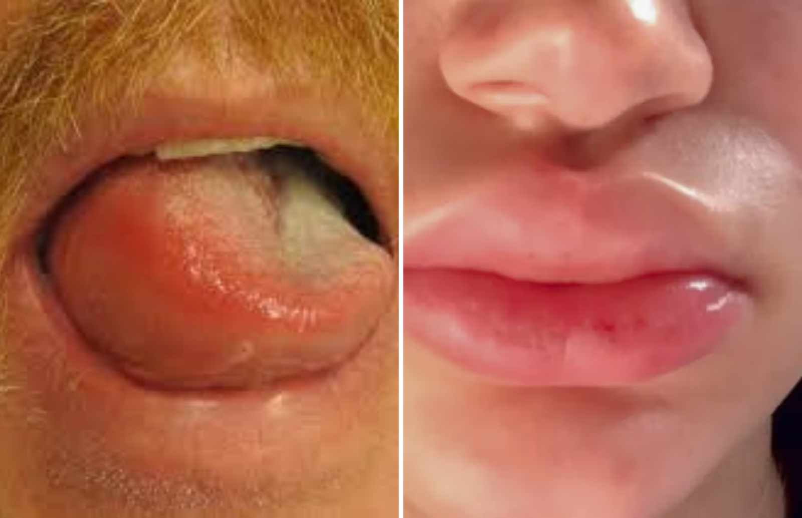 Angioedema nuotraukos