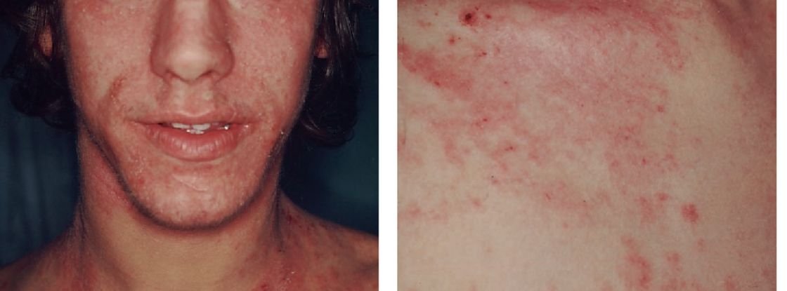Galvos kaklo ir peciu atopinis dermatitas speciali ligos forma