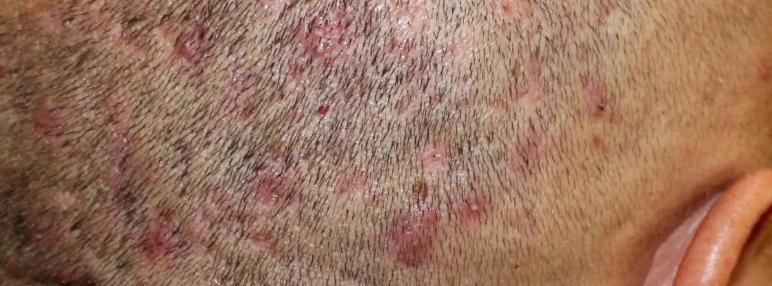 Ka daryti siuolaikines atopinio dermatito gydymo galimybes