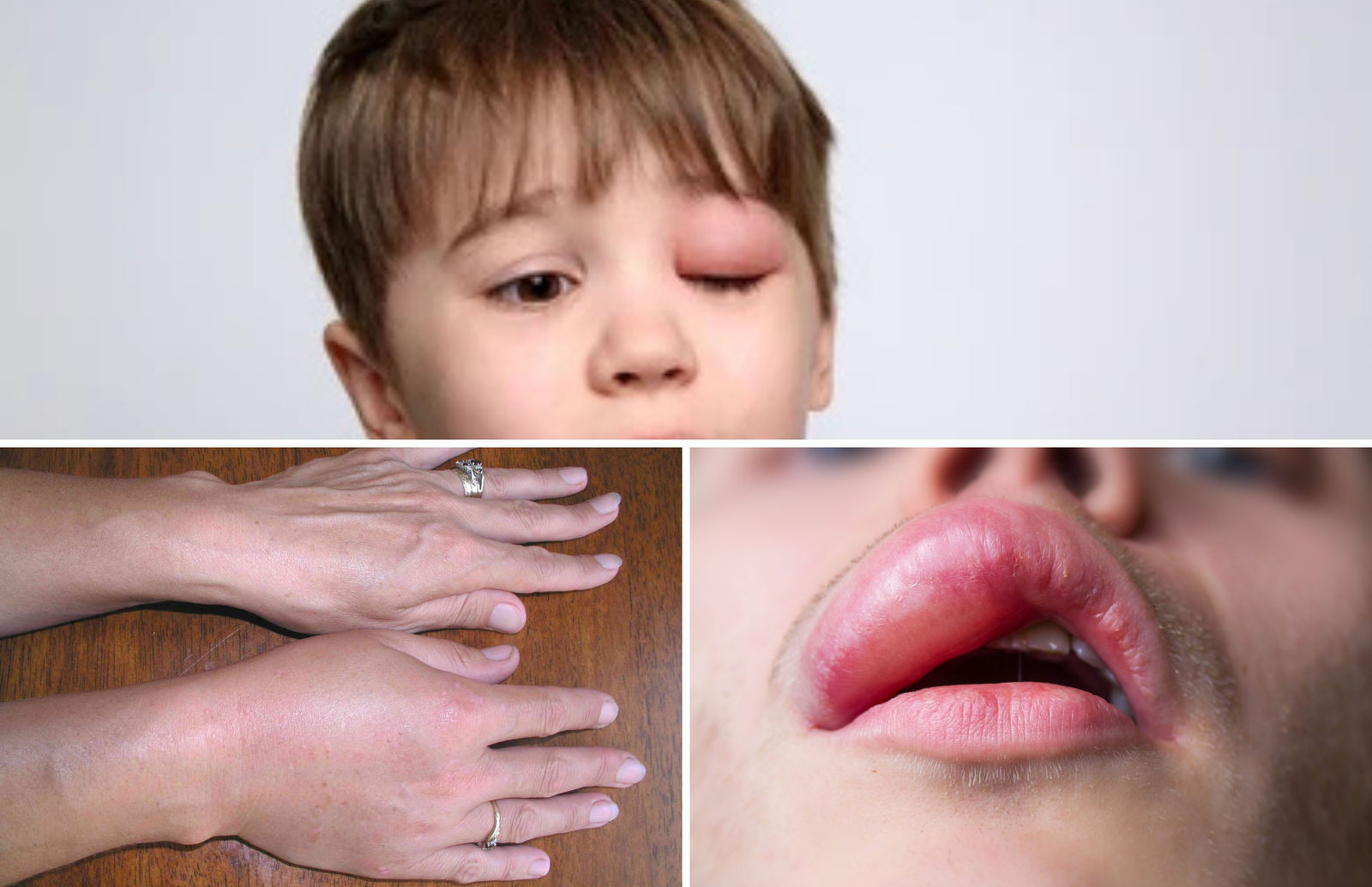 Lėtinė dilgėlinė ir angioedema nuotraukos