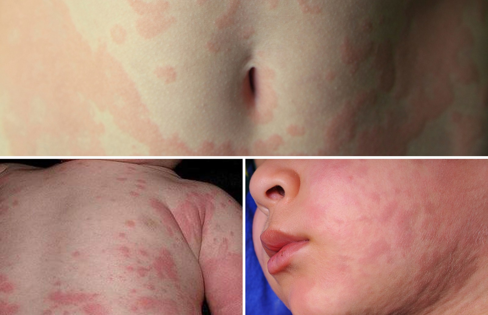 Lėtinė dilgėlinė ir angioedema nuotraukos