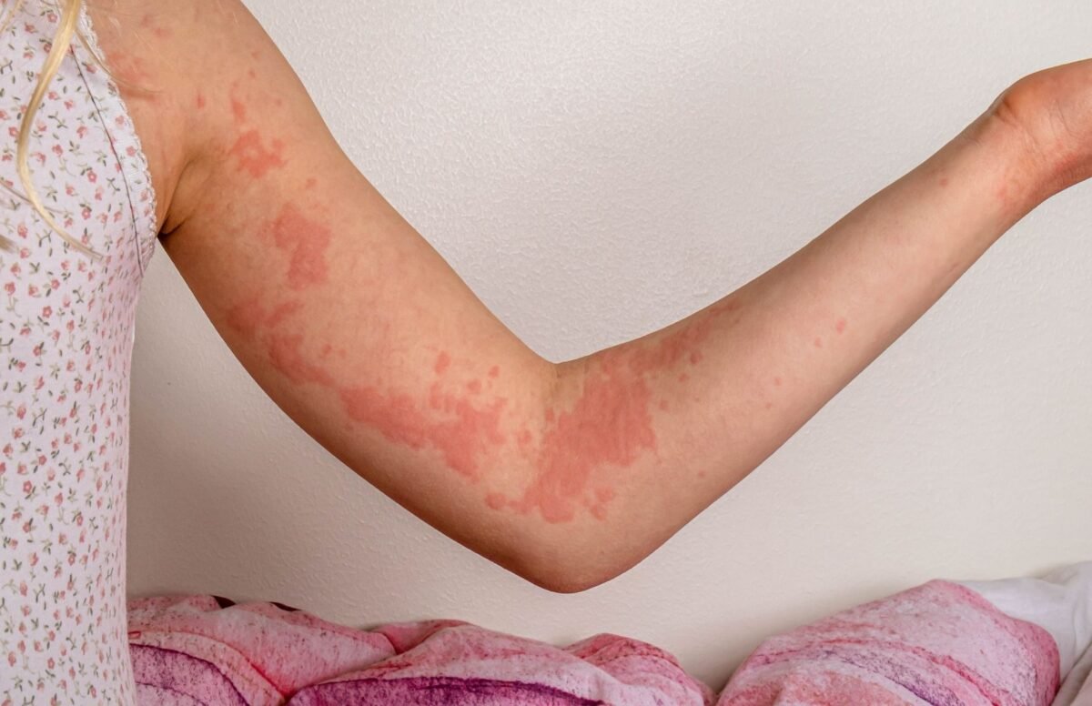 Lėtinė dilgėlinė ir angioedema: simptomai, priežastys, gydymas